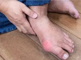 Hình ảnh về bệnh Gout